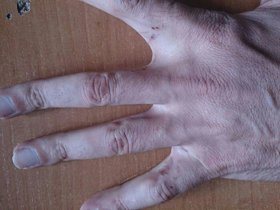 Umar Boltiev's hand. Electric burn marks are clearly visible - traces of shock torture.