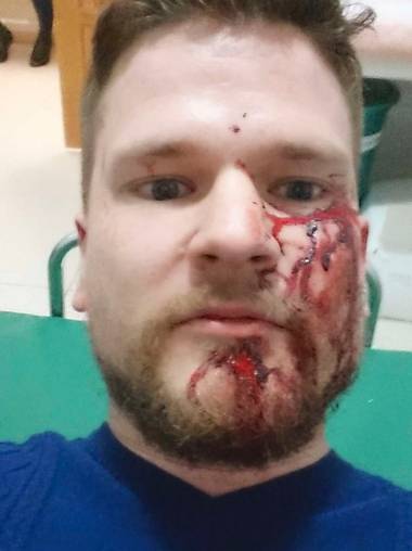 Oystein Winstad, reporter for Norwegian Ny Tad newspaper, after beating by Chechen thugs March 9, 2016